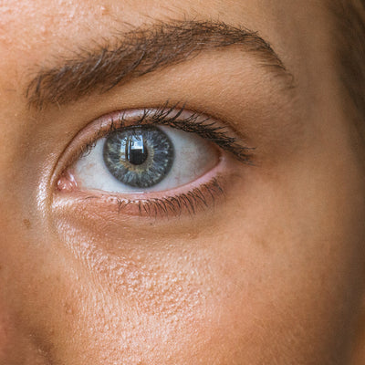 Let's Talk All Things Milia: Prevention, Causes, and Treatments