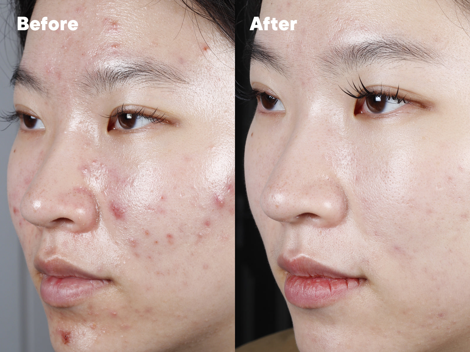 Side-by-side photos of a person’s face. The left side shows acne and redness on the skin (Before). The right side shows clearer, smoother skin with fewer blemishes (After).