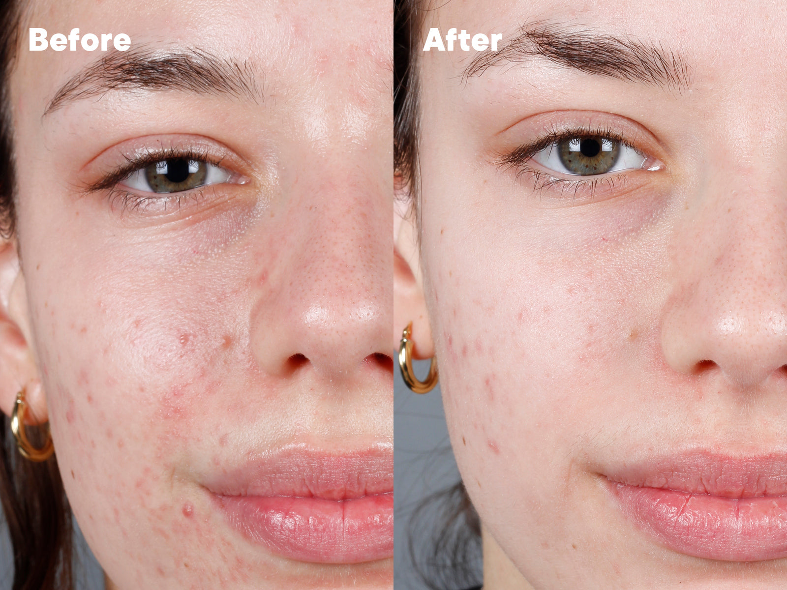 Side-by-side close-up of a womans face showing Before with visible redness and acne, and After with clearer, smoother skin and reduced redness, demonstrating skincare improvement.