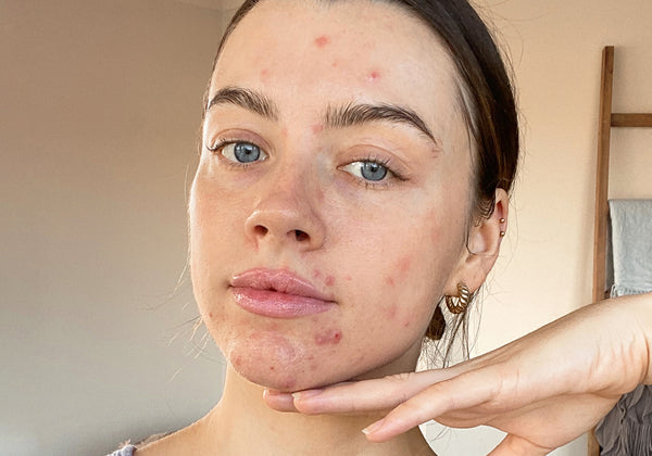 Maddie Edwards on Ditching Filters and Embracing Her Skin