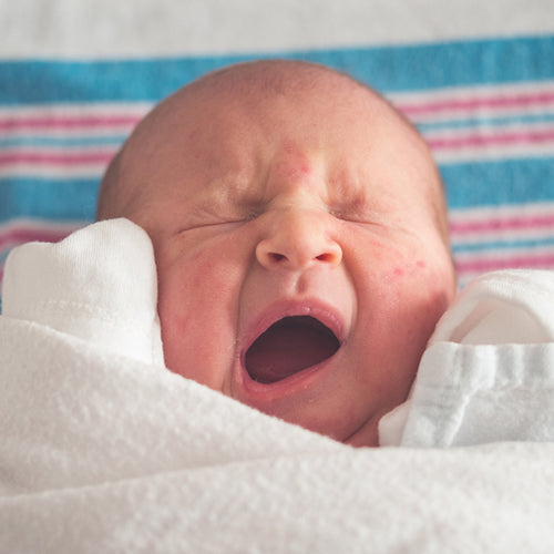 Dr Golly says newborn acne is completely normal.