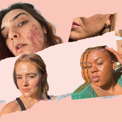 Refresh Your Feed With These Acne-Positive Faces