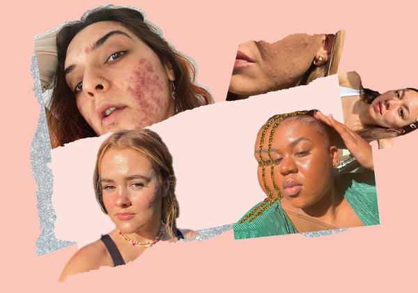 Refresh Your Feed With These Acne-Positive Faces